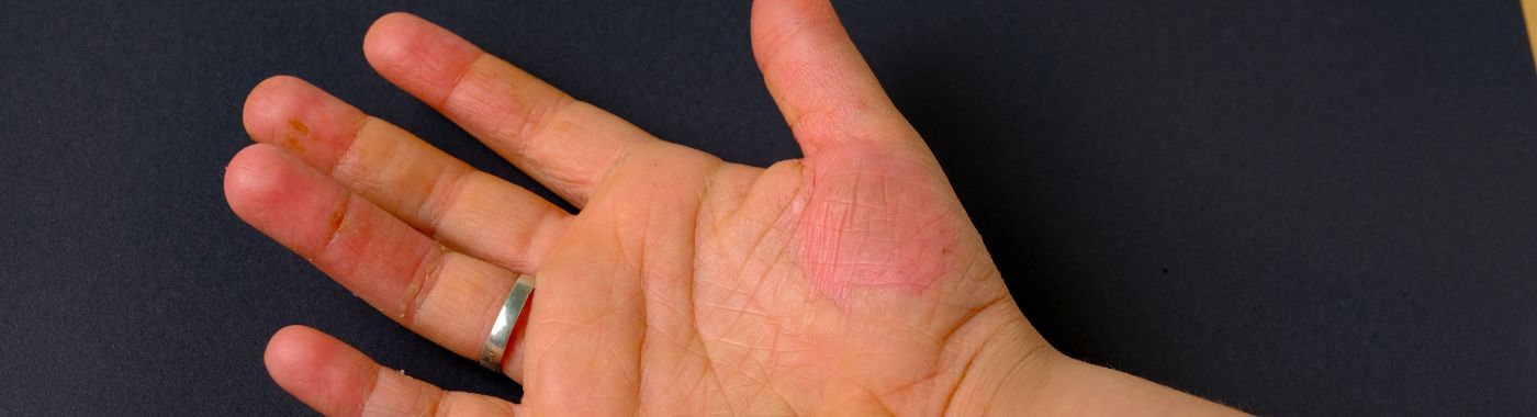 Erythema Nodosum - Causes, Symptoms, Diagnosis, Treatment, and Prevention