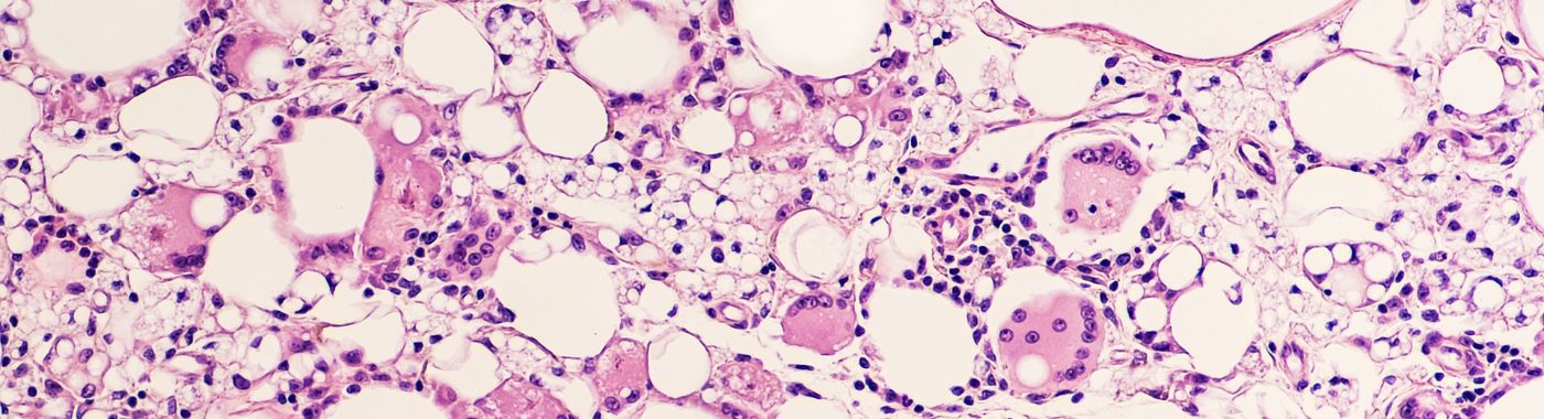 Fat Necrosis - Causes, Symptoms, Diagnosis, Treatment, and Prevention