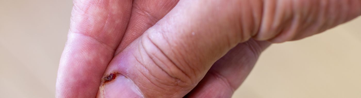 Felon Finger - Causes, Symptoms, Diagnosis, Treatment, and Prevention