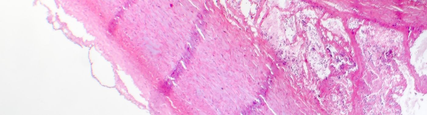 Fibrinoid Necrosis - Causes, Symptoms, Diagnosis, Treatment, and Prevention