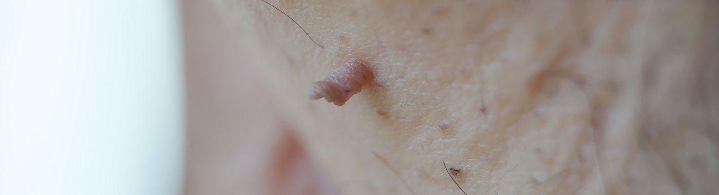 Fibroma - Causes, Symptoms, Diagnosis, Treatment, and Prevention