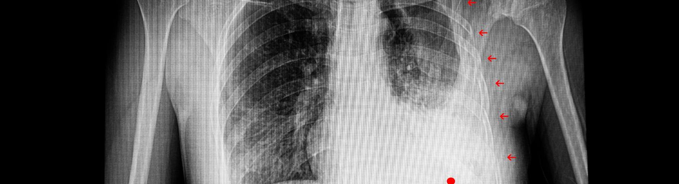 Flail Chest - Causes, Symptoms, Diagnosis, Treatment, and Prevention