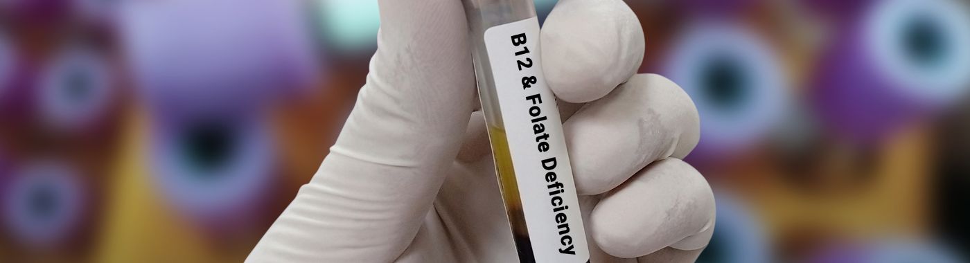 Folate Deficiency Anemia - Causes, Symptoms, Diagnosis, Treatment, and Prevention