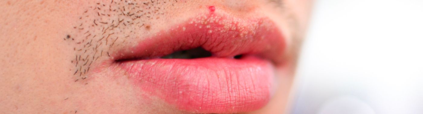 Fordyce Spots - Causes, Symptoms, Diagnosis, Treatment, and Prevention