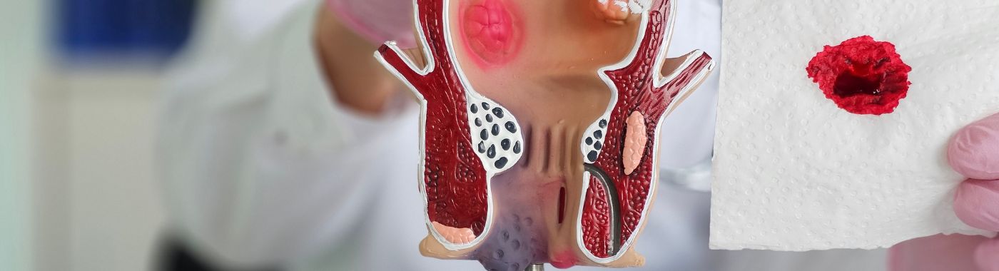 Gastrointestinal Bleeding - Causes, Symptoms, Diagnosis, Treatment, and Prevention