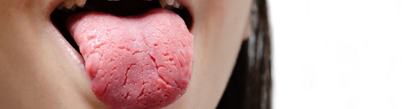 Geographic Tongue - Causes, Symptoms, Diagnosis, Treatment, and Prevention