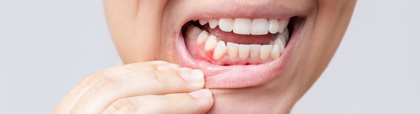 Gingivostomatitis - Causes, Symptoms, Diagnosis, Treatment, and Prevention