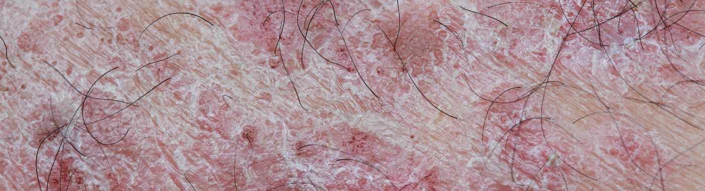 Guttate Psoriasis - Causes, Symptoms, Diagnosis, Treatment, and Prevention