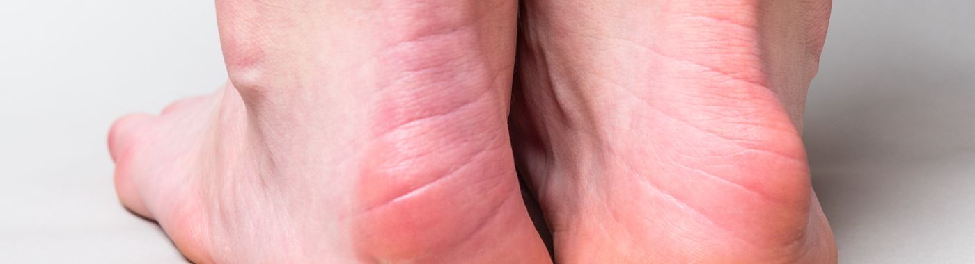 Haglunds Deformity - Causes, Symptoms, Diagnosis, Treatment, and Prevention