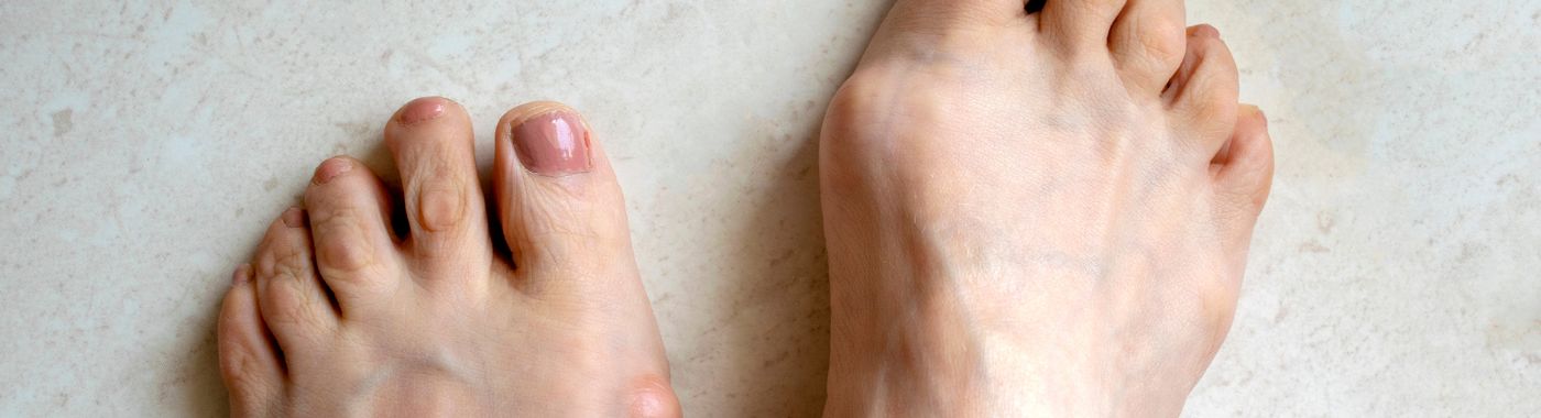 Hallux Rigidus - Causes, Symptoms, Diagnosis, Treatment, and Prevention