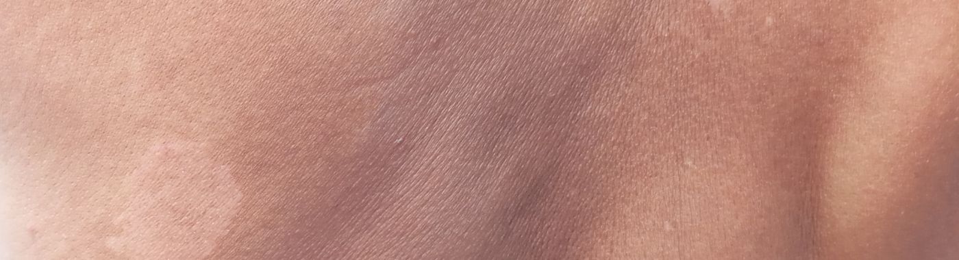 Harlequin Syndrome - Causes, Symptoms, Diagnosis, Treatment, and Prevention