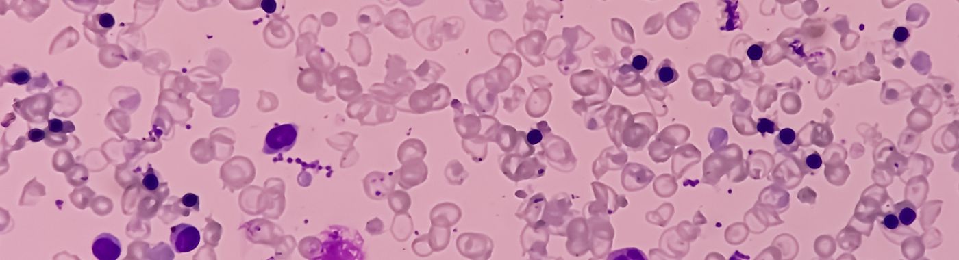 Hemolytic Anemia - Causes, Symptoms, Diagnosis, Treatment, and Prevention