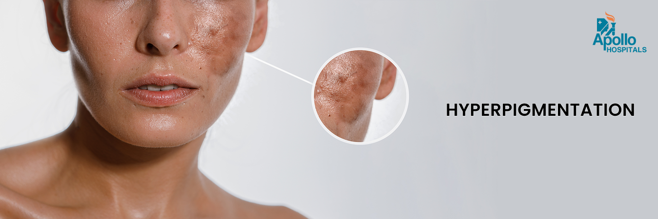 Hyperpigmentation