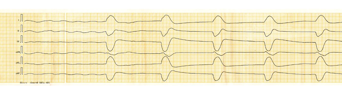 Idioventricular Rhythm - Causes, Symptoms, Diagnosis, Treatment, and Prevention