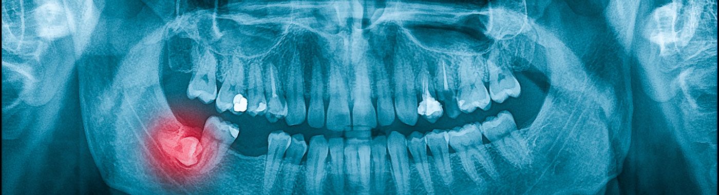 Impacted Tooth - Causes, Symptoms, Diagnosis, Treatment, and Prevention