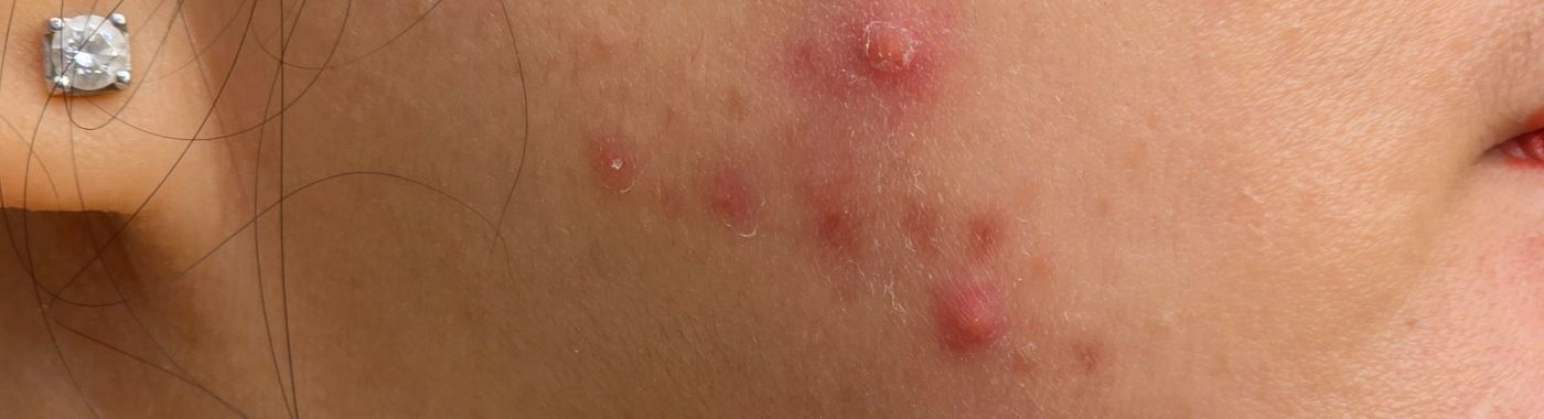 Inflammatory Acne - Causes, Symptoms, Diagnosis, Treatment, and Prevention