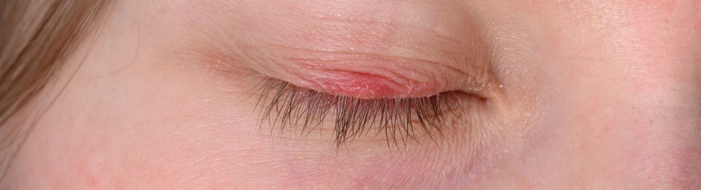 Internal Stye - Causes, Symptoms, Diagnosis, Treatment, and Prevention