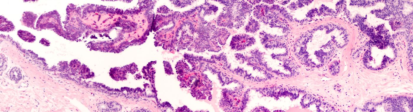 Intraductal Papilloma - Causes, Symptoms, Diagnosis, Treatment, and Prevention