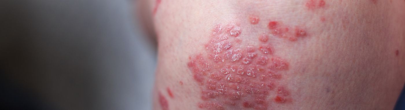 Inverse Psoriasis - Causes, Symptoms, Diagnosis, Treatment, and Prevention