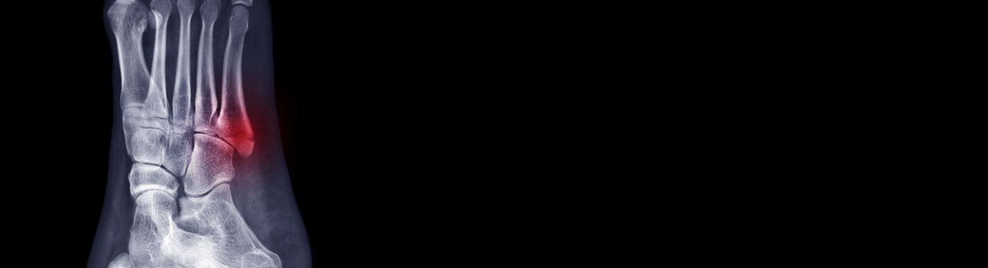 Jones Fracture - Causes, Symptoms, Diagnosis, Treatment, and Prevention