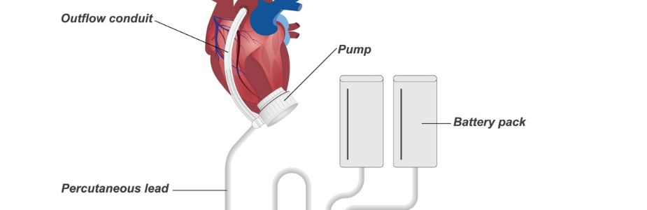 LVAD