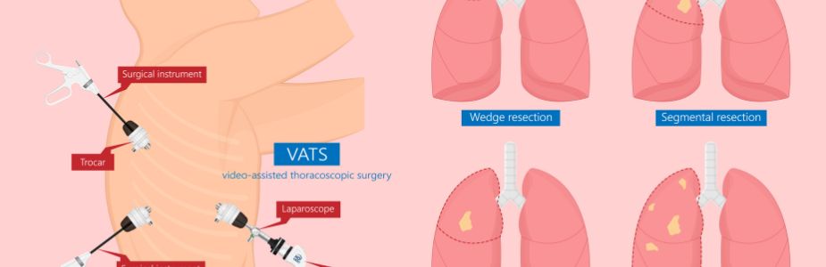 Pleuroscopy / Thoracoscopy