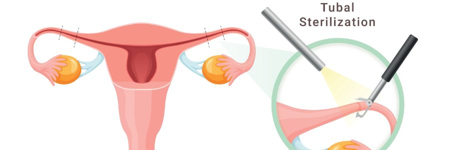 Tubal Procedures / Tubal Re-canalisation