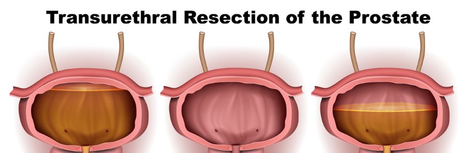 TURP