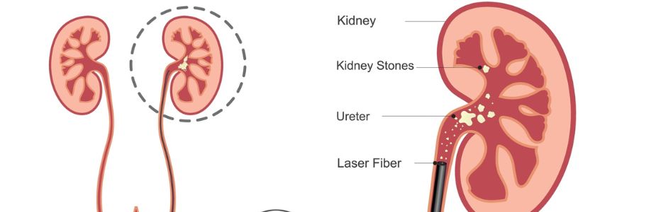 Ureteroscopy (URS) with Laser