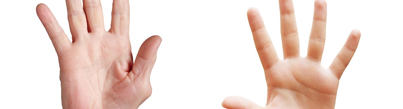 Werner Syndrome - Causes, Symptoms, Diagnosis, Treatment, and Prevention