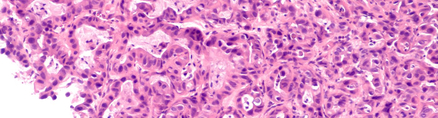 Whipple's Disease - Causes, Symptoms, Diagnosis, Treatment, and Prevention