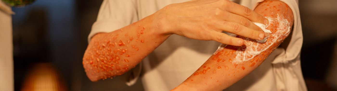 Burns - Causes, Symptoms, Diagnosis, Treatment, and Prevention