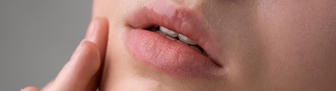 Cold Sores - Causes, Symptoms, Diagnosis, Treatment, and Prevention