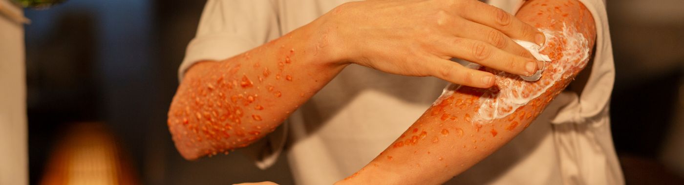 Epidermolysis Bullosa - Causes, Symptoms, Diagnosis, Treatment, and Prevention