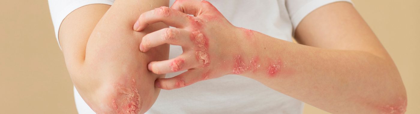 Granuloma - Causes, Symptoms, Diagnosis, Treatment, and Prevention