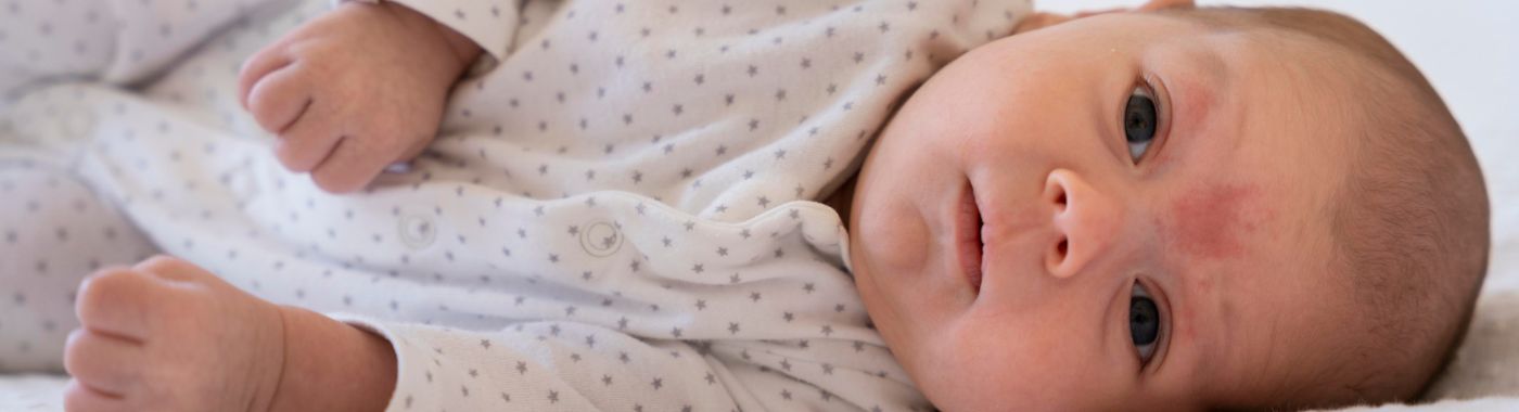 Harlequin Ichthyosis - Causes, Symptoms, Diagnosis, Treatment, and Prevention