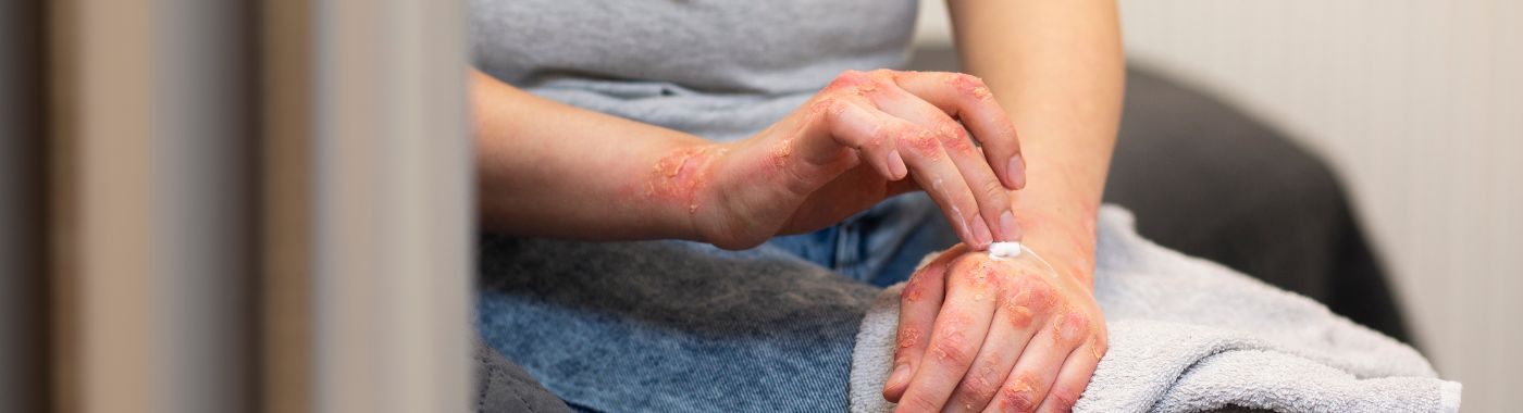 Herpetic Whitlow - Causes, Symptoms, Diagnosis, Treatment, and Prevention