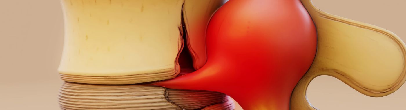 Hip Fracture - Causes, Symptoms, Diagnosis, Treatment, and Prevention