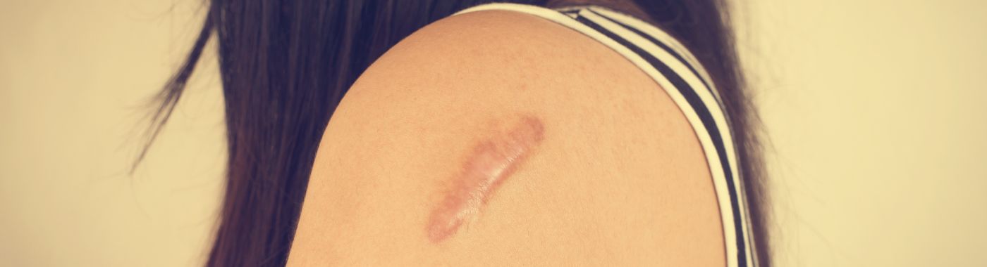 Hypertrophic Scar - Causes, Symptoms, Diagnosis, Treatment, and Prevention