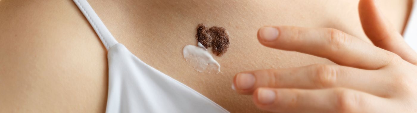 Keloid Scar - Causes, Symptoms, Diagnosis, Treatment, and Prevention