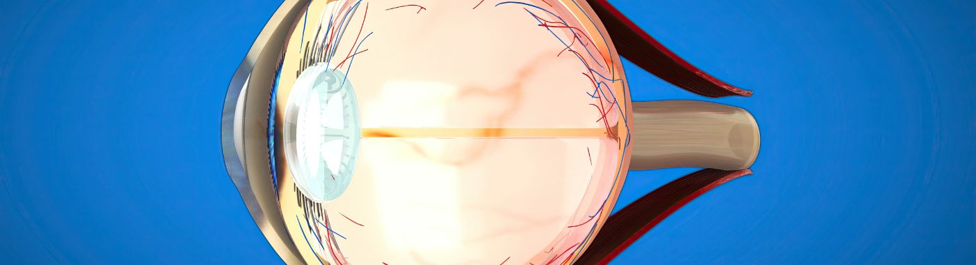 Lattice Degeneration - Causes, Symptoms, Diagnosis, Treatment, and Prevention