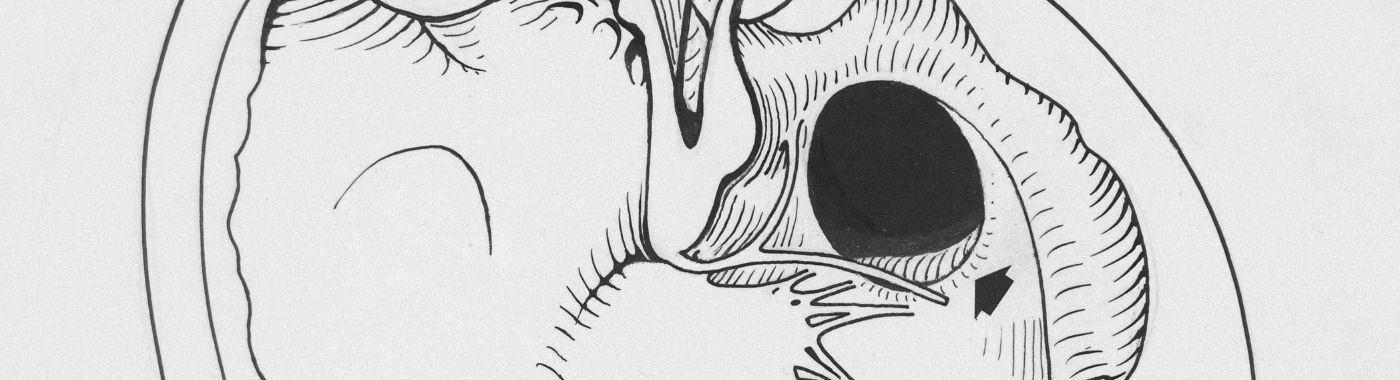 Left Ventricular Hypertrophy - Causes, Symptoms, Diagnosis, Treatment, and Prevention