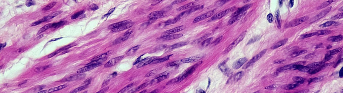 Leiomyosarcoma - Causes, Symptoms, Diagnosis, Treatment, and Prevention