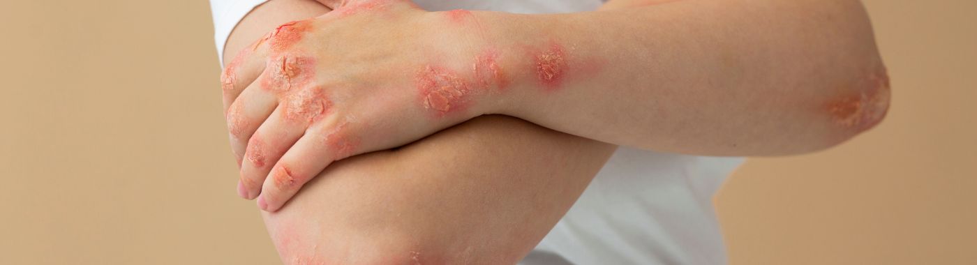 Leishmaniasis - Causes, Symptoms, Diagnosis, Treatment, and Prevention