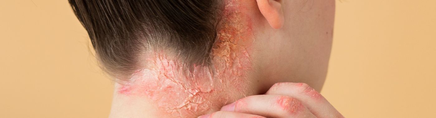 Lichen Planopilaris - Causes, Symptoms, Diagnosis, Treatment, and Prevention