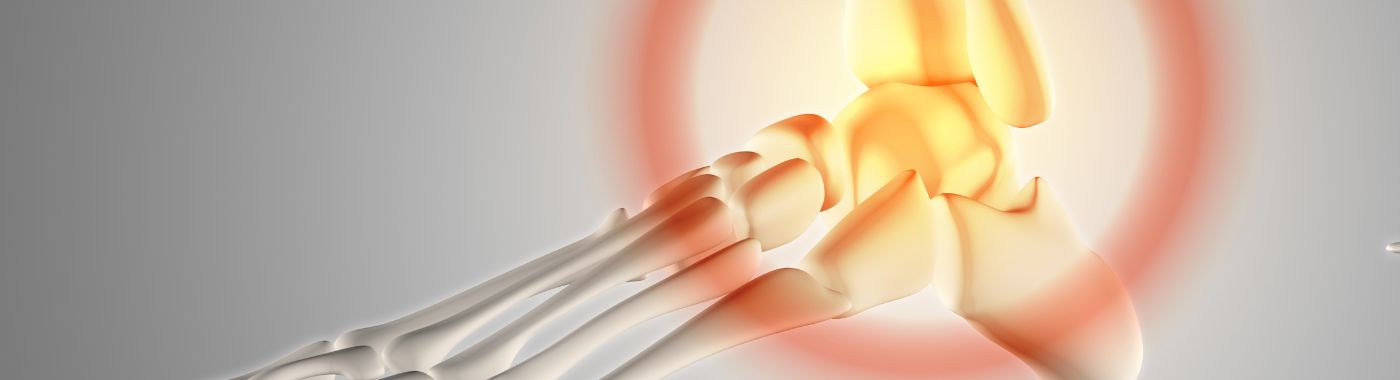 Lisfranc Fracture - Causes, Symptoms, Diagnosis, Treatment, and Prevention