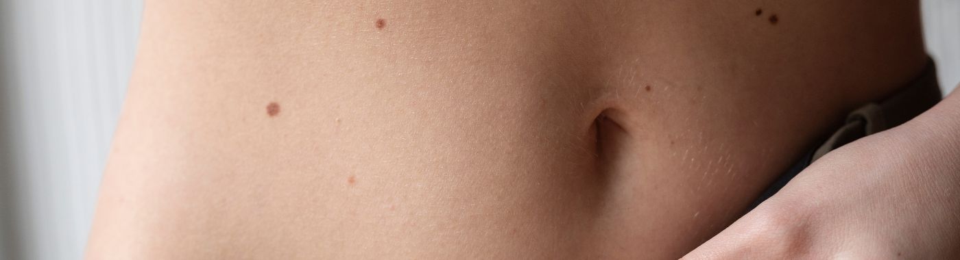 Liver Spots - Causes, Symptoms, Diagnosis, Treatment, and Prevention