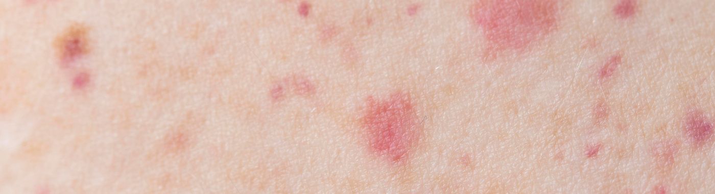 Mastocytosis - Causes, Symptoms, Diagnosis, Treatment, and Prevention