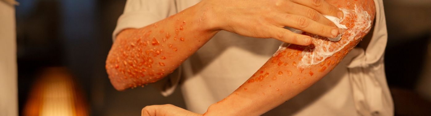 Meningococcal Disease - Causes, Symptoms, Diagnosis, Treatment, and Prevention