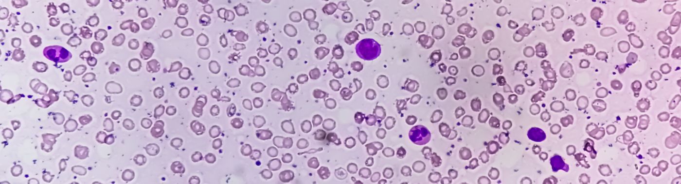 Microcytosis - Causes, Symptoms, Diagnosis, Treatment, and Prevention